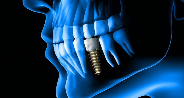 DENTAL IMPLANT