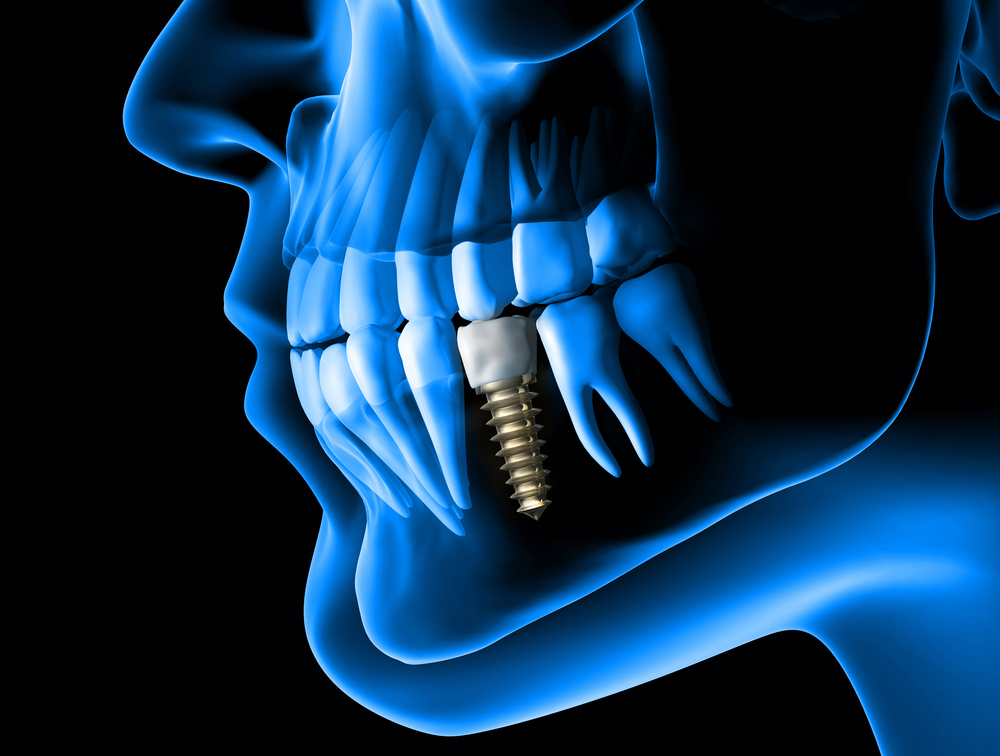 Dental Implants All Alaska Oral Craniofacial Surgery