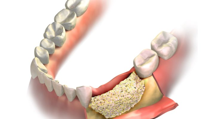 Bone Grafting