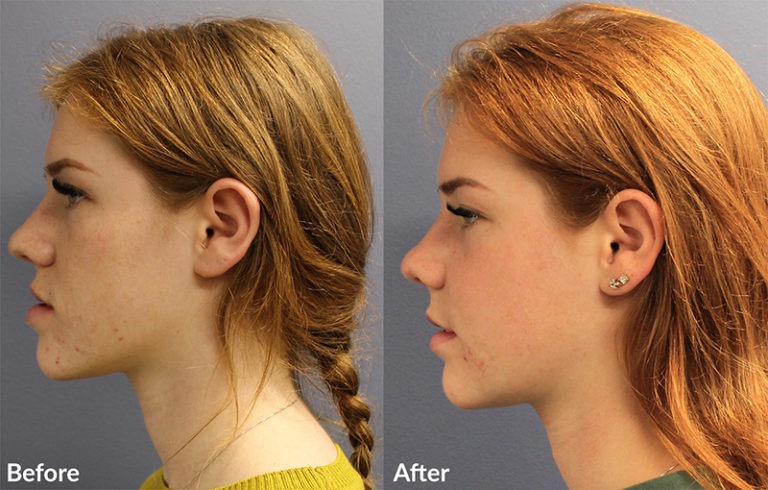 orthognathic-surgery-all-alaska-oral-craniofacial-surgery
