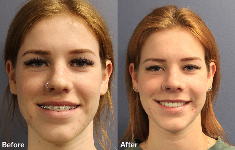 Overbite jaw discount